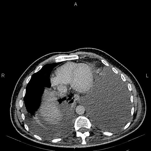Non Hodgkin lymphoma in a patient with ankylosing spondylitis (Radiopaedia 84323-99621 Axial C+ delayed 5).jpg