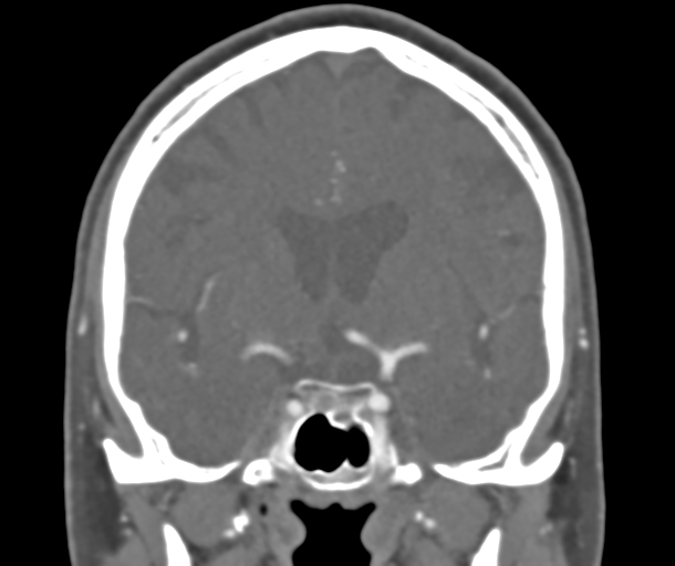 File:Normal CTA head (Radiopaedia 40801-43464 B 45).png