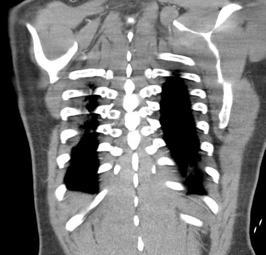 File:Normal CTA thorax (non ECG gated) (Radiopaedia 41750-44704 B 74).png