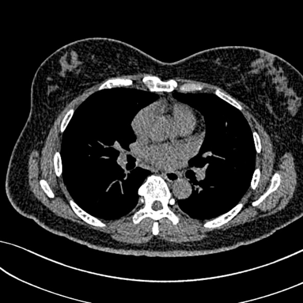 Normal CT chest- adult female (Radiopaedia 52522-58428 Axial non-contrast 67).jpg
