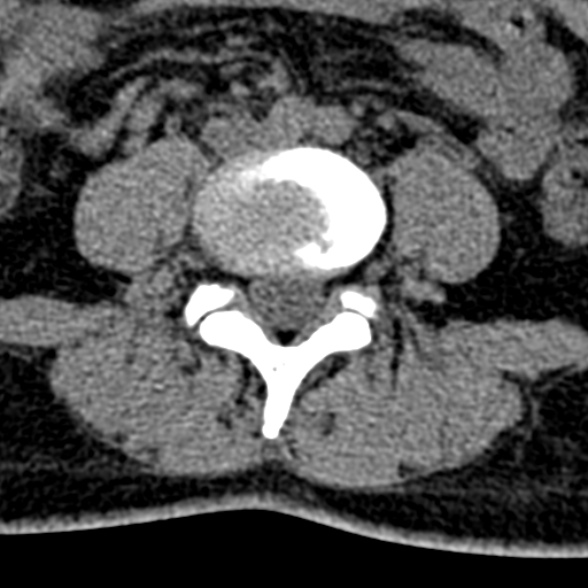 Normal CT lumbar spine (Radiopaedia 53981-60118 Axial non-contrast 69).jpg