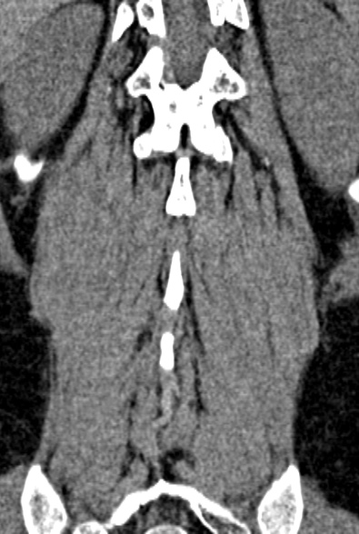 Normal CT lumbar spine (Radiopaedia 53981-60118 F 81).jpg