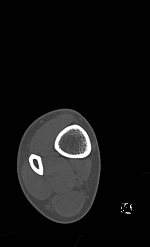 Normal CT of the ankle (Radiopaedia 47111-51658 Axial bone window 2).jpg