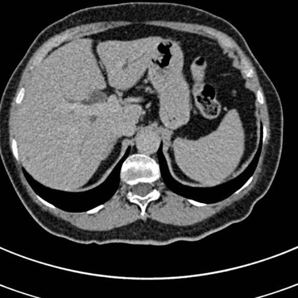 File:Normal CT split bolus study of the renal tract (Radiopaedia 48631-53634 Axial split bolus 5).jpg