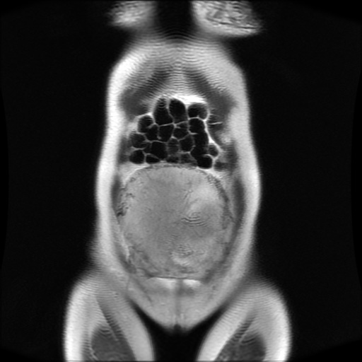 File:Normal MRI abdomen in pregnancy (Radiopaedia 88001-104541 Coronal T2 7).jpg