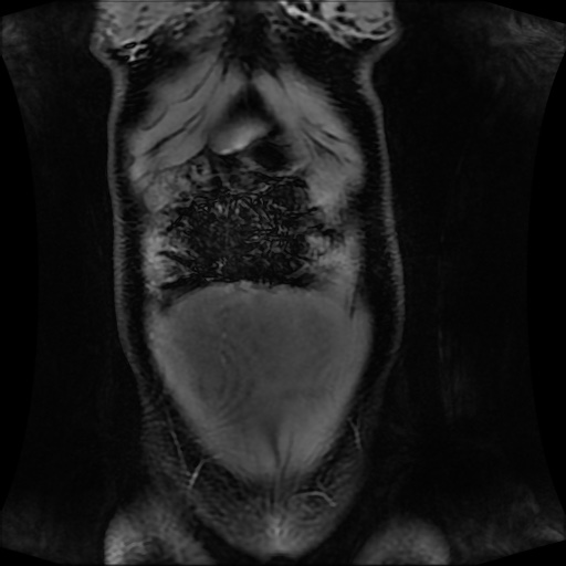 Normal MRI abdomen in pregnancy (Radiopaedia 88001-104541 M 32).jpg