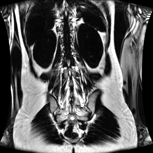 Normal MRI abdomen in pregnancy (Radiopaedia 88001-104541 N 108).jpg