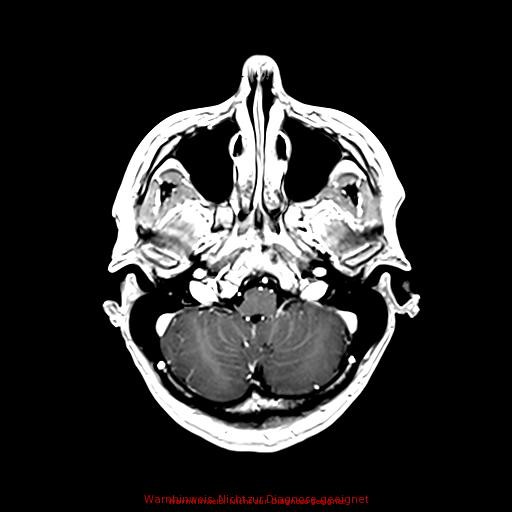 Normal adult brain MRI (non-enhanced and contrast-enhanced) (Radiopaedia 75262-86379 Axial T1 C+ 57).jpg
