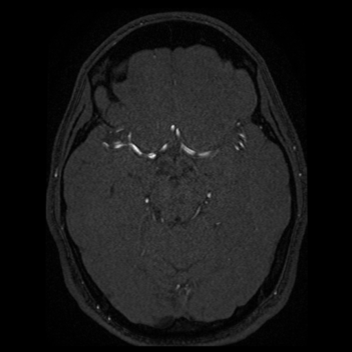 Normal brain MRA (Radiopaedia 41046-43793 Axial MRA 50).png