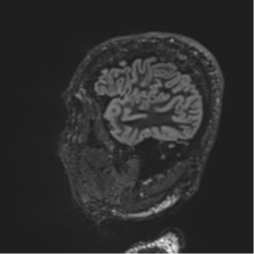 Normal brain MRI (non-focal epilepsy protocol) (Radiopaedia 53917-60040 Sagittal DIR 14).png