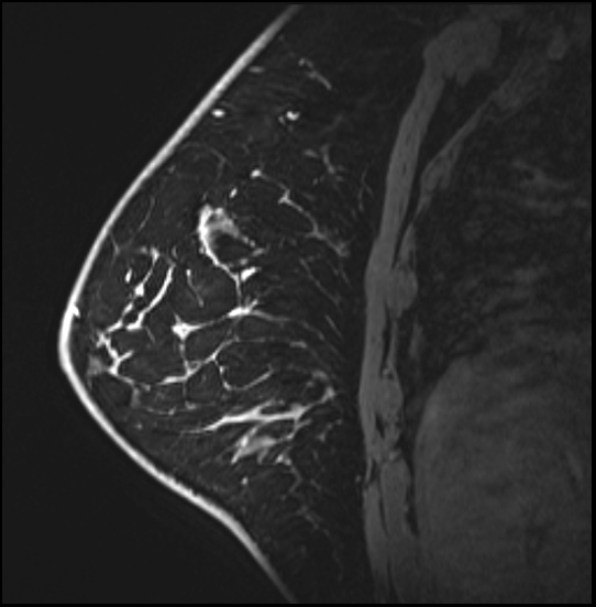 Normal breast MRI - dense breasts (Radiopaedia 80454-93850 I 130).jpg