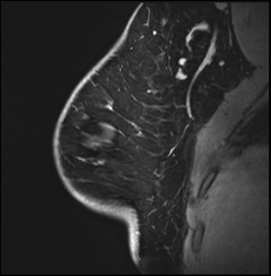 Normal breast MRI - dense breasts (Radiopaedia 80454-93850 I 52).jpg