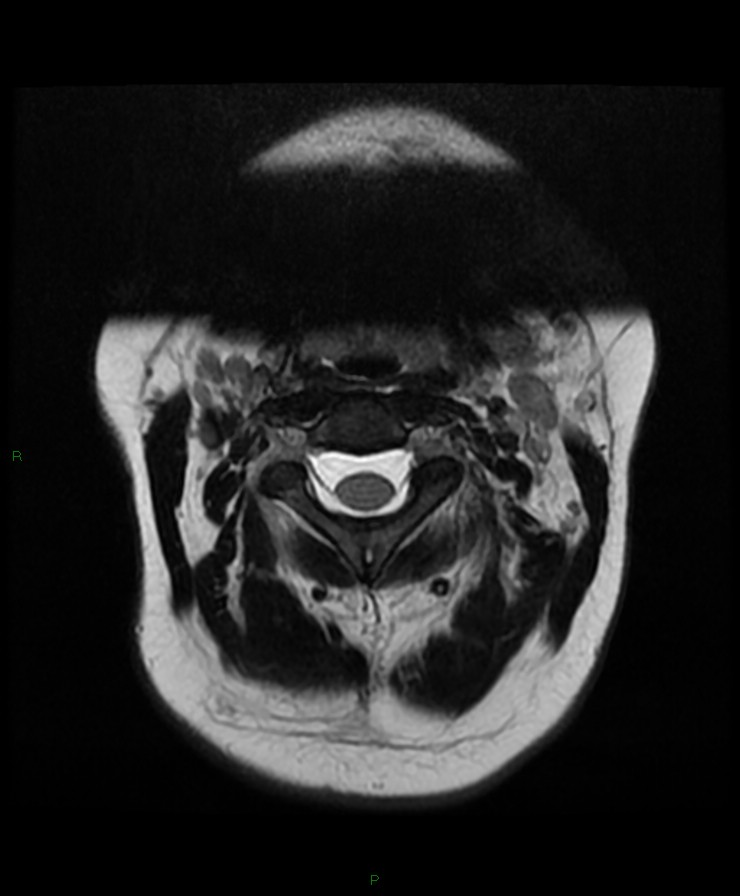 Normal cervical spine MRI (Radiopaedia 80146-93454 Axial T2 13).jpg