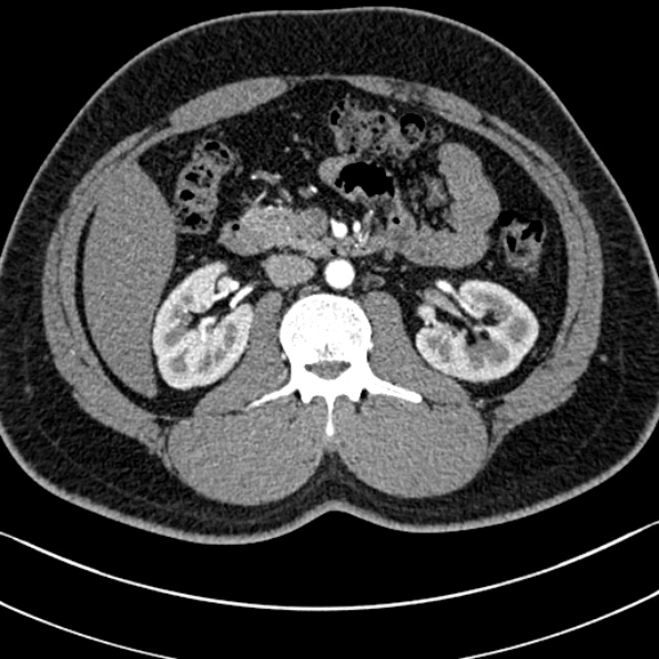 Normal kidneys on 4-phase CT study (Radiopaedia 25889-26038 B 41).jpg