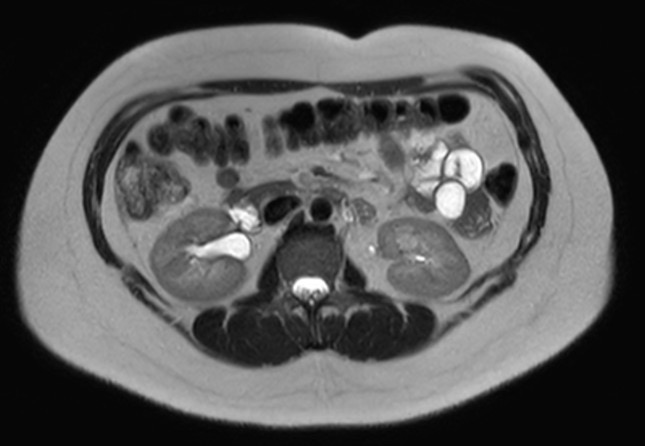 File:Normal liver MRI with Gadolinium (Radiopaedia 58913-66163 Axial T2 11).jpg