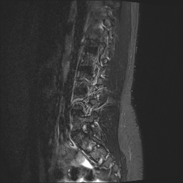 File:Normal lumbar spine MRI- 3 T (Radiopaedia 53280-59250 Sagittal STIR 7).jpg