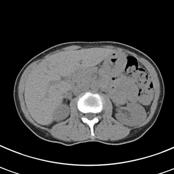 File:Normal multiphase CT liver (Radiopaedia 38026-39996 Axial non-contrast 29).jpg