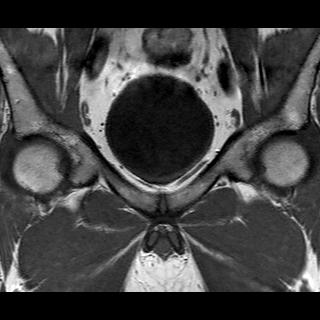 File:Normal prostate (MRI) (Radiopaedia 29986-30535 Coronal T1 4).jpg