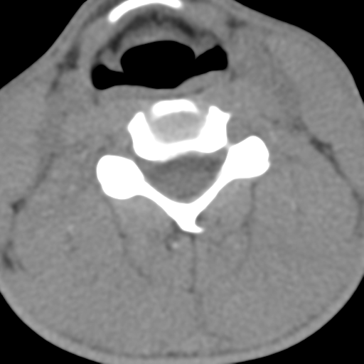 Normal trauma cervical spine (Radiopaedia 41017-43760 Axial non-contrast 33).png