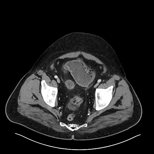 Obstructing sigmoid adenocarcinoma (Radiopaedia 58465-65619 A 144).jpg