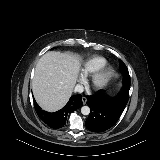 File:Obstructing sigmoid adenocarcinoma (Radiopaedia 58465-65619 Axial 143).jpg