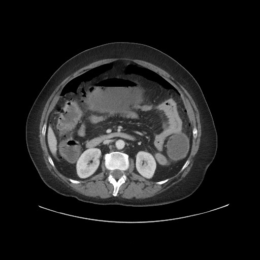 Obstructive distal colonic adenocarcinoma causing cecal perforation (Radiopaedia 86830-102989 A 88).jpg