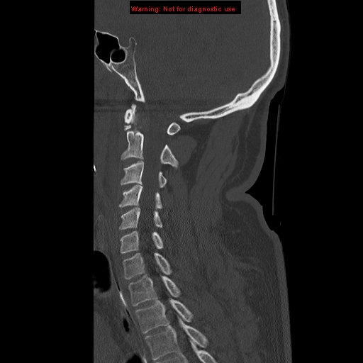 File:Occipital condyle fracture (Radiopaedia 18366-18208 Sagittal bone window 22).jpg