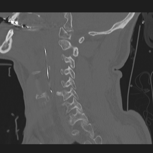 File:Occipital condyle fracture (Radiopaedia 33467-34517 Sagittal bone window 26).png