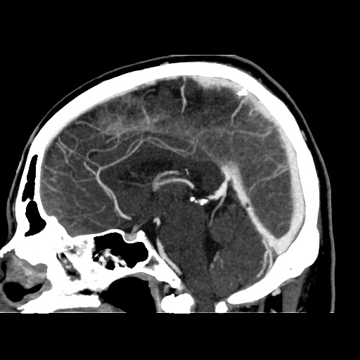 Occipital extradural hematoma simulating venous sinus thrombosis (Radiopaedia 46514-50964 D 40).jpg