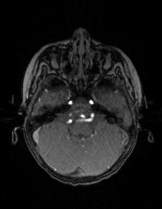 Occipital horn syndrome (Radiopaedia 14255-14129 MRA 36).jpg