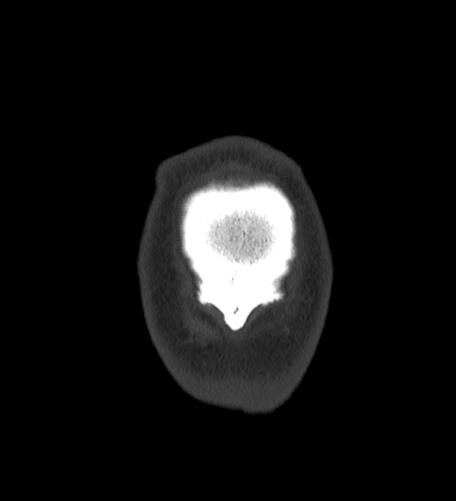 Occipital spur and Currarino type A atlas anomaly (Radiopaedia 87027-103285 Coronal bone window 145).jpg