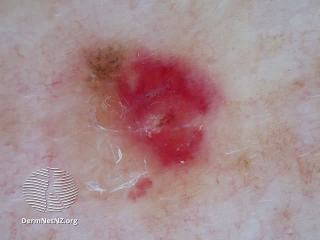 File:Pigment remnants (DermNet NZ doctors-dermoscopy-course-images-amelanotic3).jpg