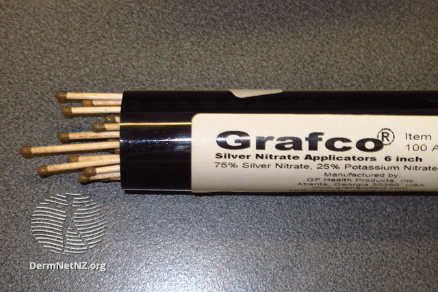 File:Silver nitrate sticks (DermNet NZ treatments-silver-nitrate-sticks).jpg