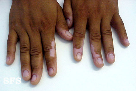 File:Vitiligo (Dermatology Atlas 2).jpg