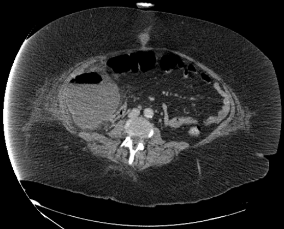 File:Abdominal abscess - pre and post percutaneous drainage (Radiopaedia 60209-67816 Axial 16).png