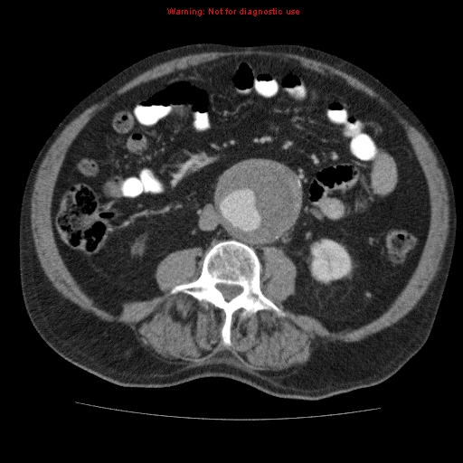Abdominal aortic aneurysm (Radiopaedia 10122-10660 Axial C+ portal venous phase 43).jpg