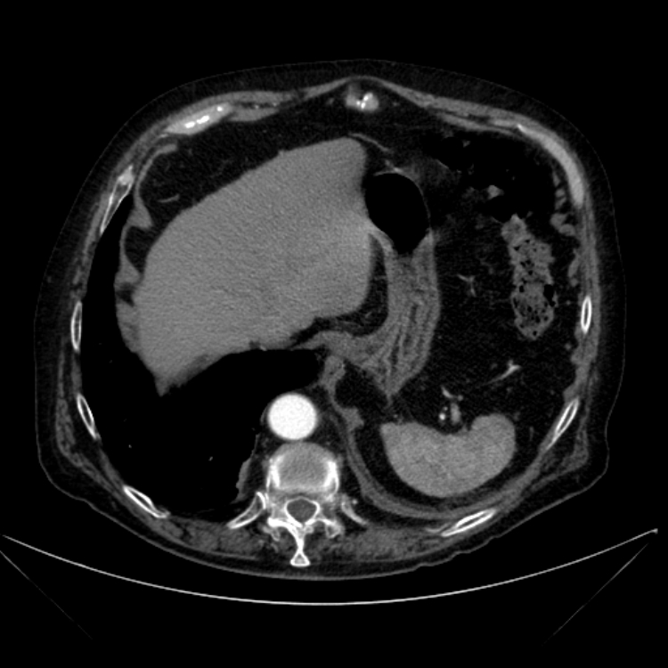 Abdominal aortic aneurysm (Radiopaedia 25855-26001 Axial C+ arterial phase 27).jpg