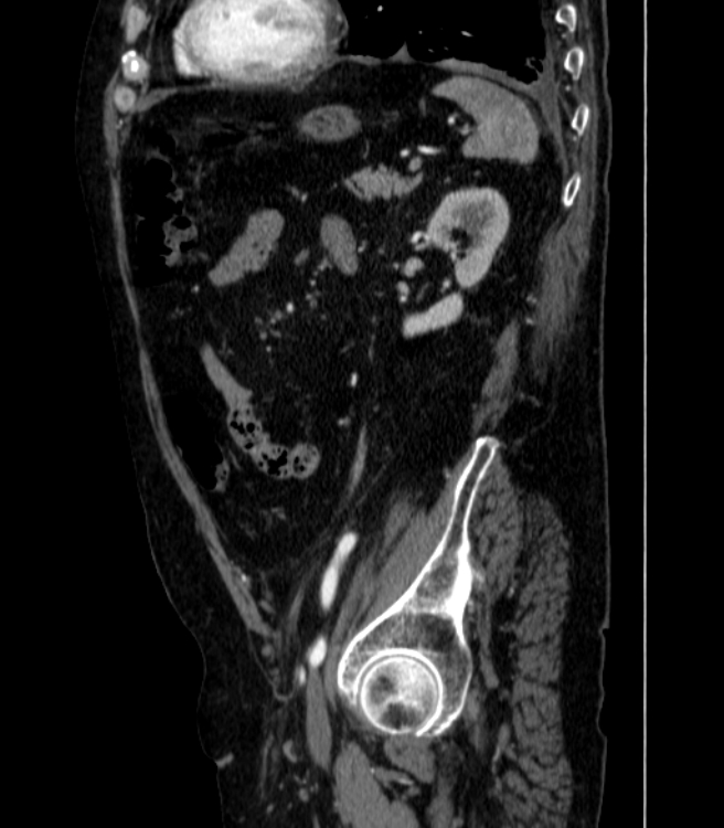 Abdominal aortic aneurysm (Radiopaedia 25855-26001 Sagittal C+ arterial phase 56).jpg