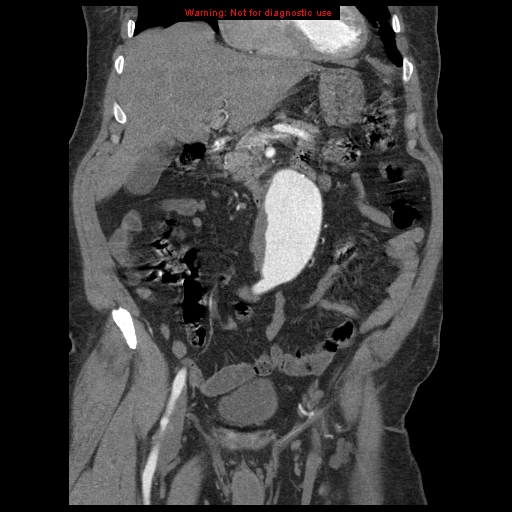 Abdominal aortic aneurysm (Radiopaedia 8190-9038 Coronal C+ arterial phase 45).jpg