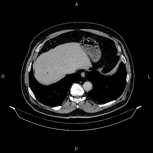 Abdominal aortic aneurysm (Radiopaedia 83094-97462 Axial renal excretory phase 17).jpg