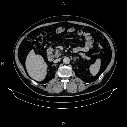 File:Abdominal aortic aneurysm (Radiopaedia 83094-97462 Axial renal excretory phase 41).jpg
