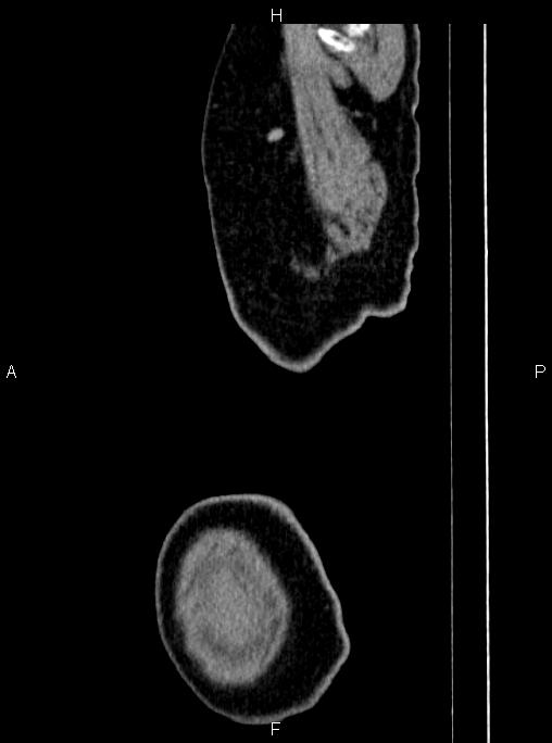 Abdominal aortic aneurysm (Radiopaedia 83094-97462 Sagittal renal cortical phase 2).jpg