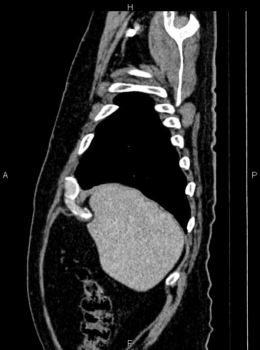 Abdominal aortic aneurysm (Radiopaedia 83094-97462 Sagittal renal cortical phase 21).jpg