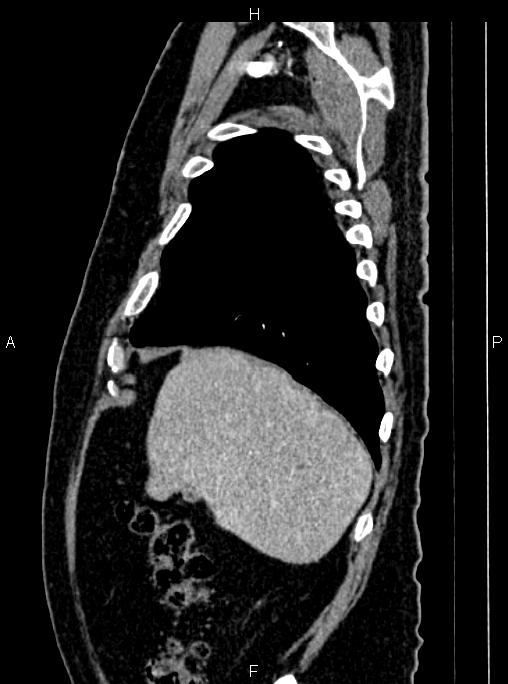 Abdominal aortic aneurysm (Radiopaedia 83094-97462 Sagittal renal cortical phase 25).jpg