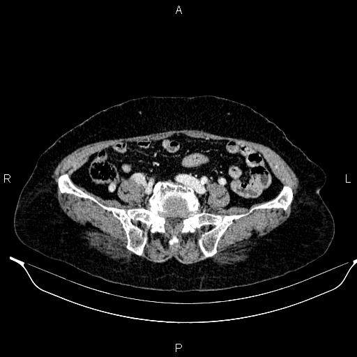 File:Abdominal aortic aneurysm (Radiopaedia 85063-100606 Axial C+ portal venous phase 52).jpg