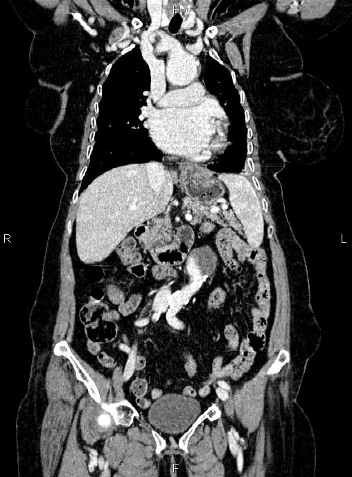 Abdominal aortic aneurysm (Radiopaedia 85063-100606 Coronal C+ arterial phase 23).jpg