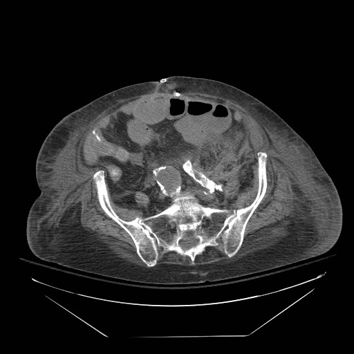 File:Abdominal aortic aneurysm - impending rupture (Radiopaedia 19233-19247 Axial non-contrast 122).jpg