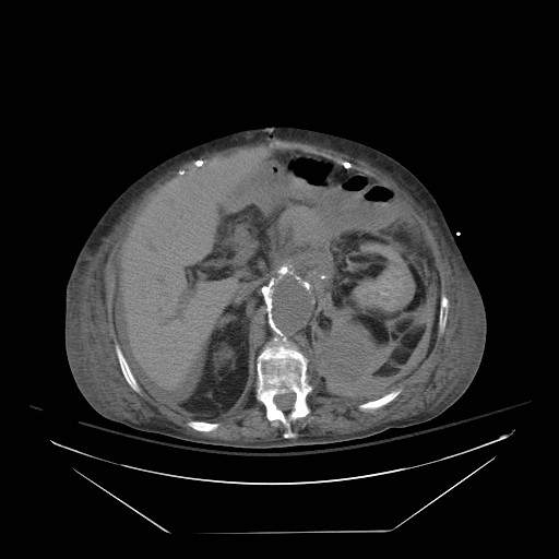 Abdominal aortic aneurysm - impending rupture (Radiopaedia 19233-19247 Axial non-contrast 62).jpg