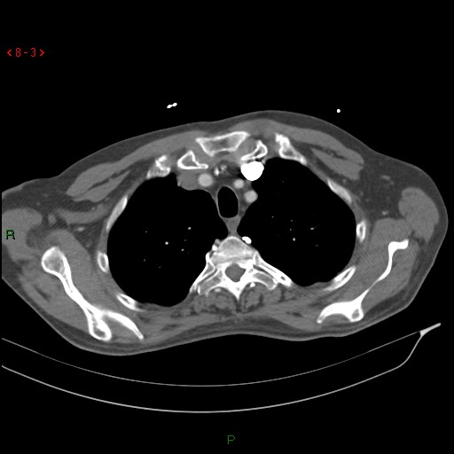 Abdominal aortic aneurysm rupture with aortocaval fistula (Radiopaedia 14897-14841 Axial C+ arterial phase 3).jpg