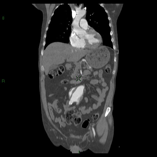 File:Abdominal aortic aneurysm rupture with aortocaval fistula (Radiopaedia 14897-14841 Coronal C+ arterial phase 21).jpg